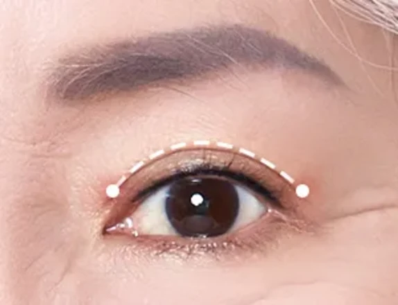 상부 안검 성형술