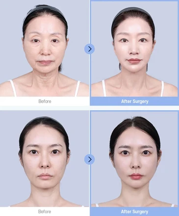 지방주입(풀페이스)