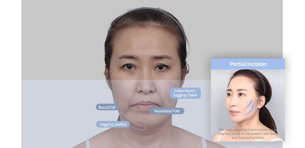 지방주입(풀페이스)