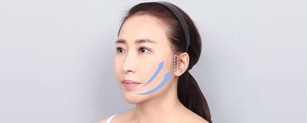 풀 페이스 리프팅