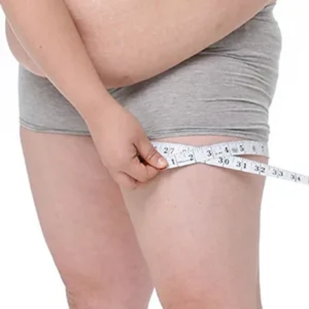 지방흡입(복부)