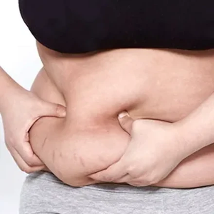 지방흡입(복부)