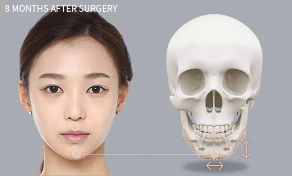 3개 안면윤곽술