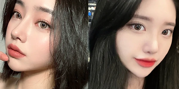 상부 안검 성형술